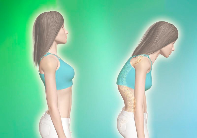 Что такое грудинно-ключично-сосцевидная мышца и как она связана с плохой осанкой? Что такое грудинно-ключично-сосцевидная мышца и как она связана с плохой осанкой?