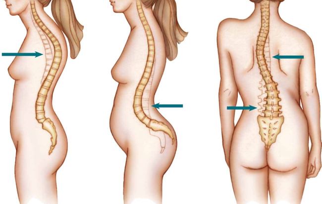 Способы диагностики симптомов грудного кифоза Способы диагностики симптомов грудного кифоза
