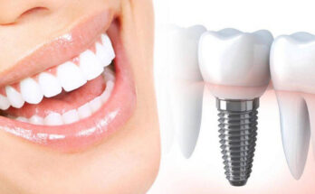 Имплантация зубов в Москве