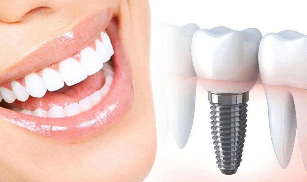 Имплантация зубов в Москве