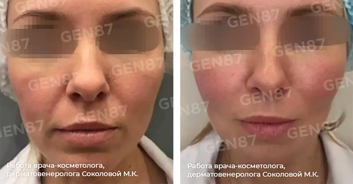 Программа омоложения: как вернуть молодость коже?