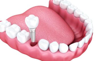 Протезирование зубов: основные виды и их цены