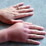 Что такое отек руки?