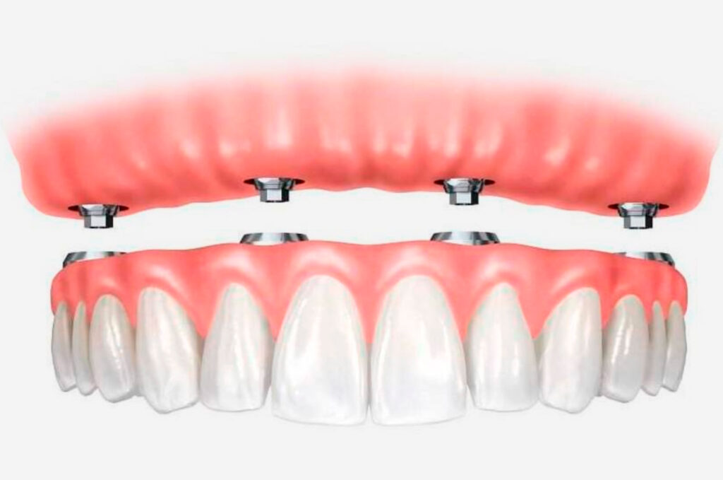 Что такое технология All-on-4?