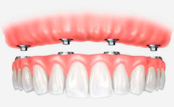 Что такое технология All-on-4?