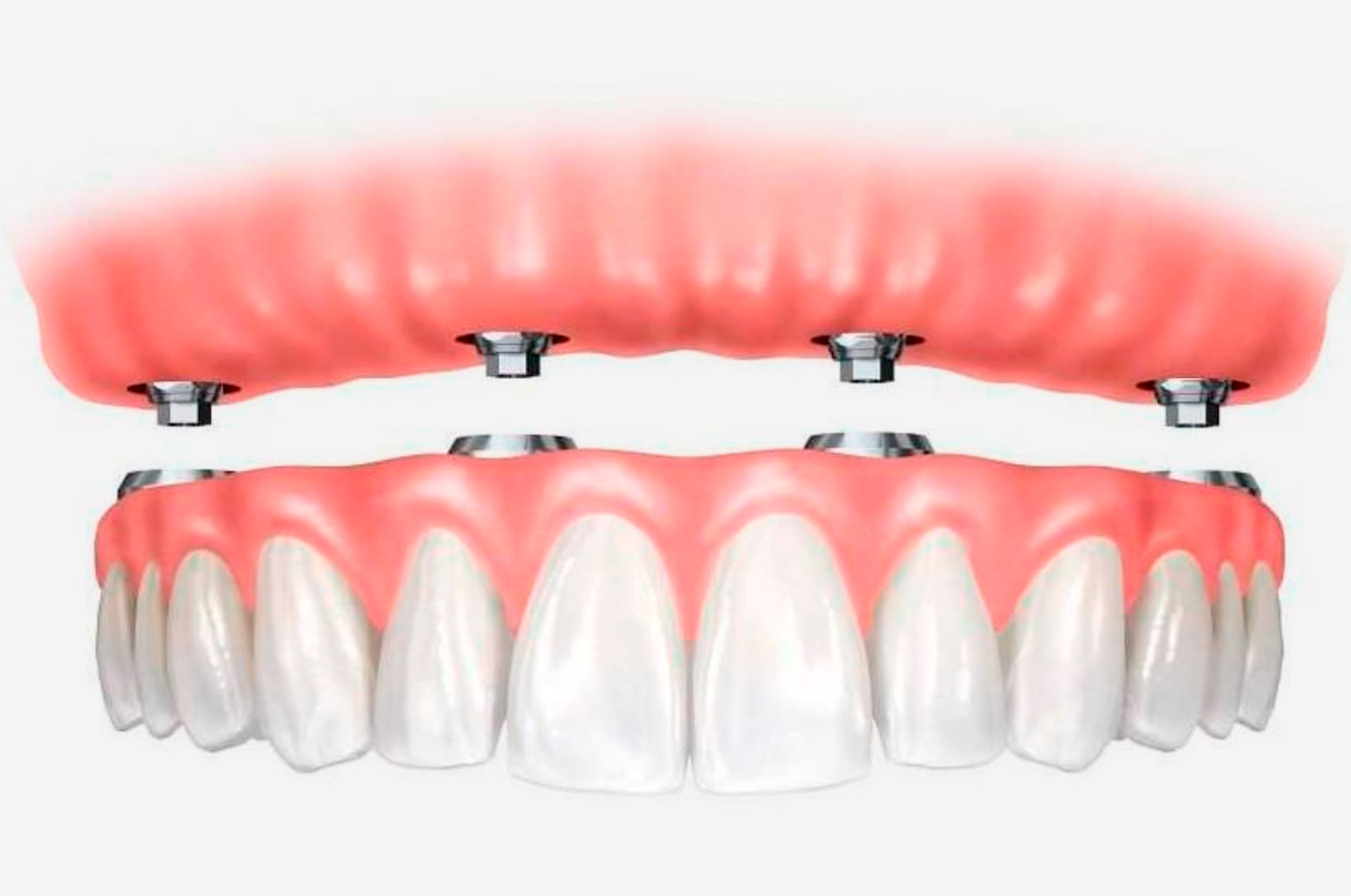 Что такое технология All-on-4?