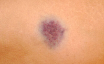 Саркома мягких тканей: понятие и классификация