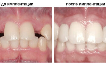 Имплантация зубов под ключ в Уфе: цена, отзывы и запись