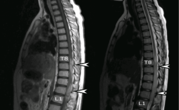 Что такое МРТ позвоночника? Что такое МРТ позвоночника?