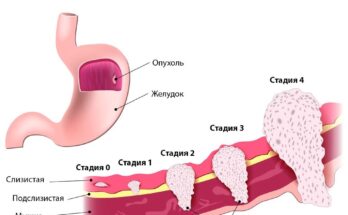 Гастрит желудка: причины, симптомы и диагностика Гастрит желудка: причины, симптомы и диагностика