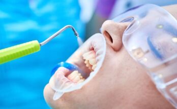 Чистка зубов у стоматолога в Сочи