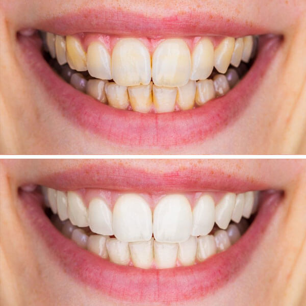 Профессиональная чистка зубов в Алматы