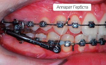 Выравнивание зубов брекетами