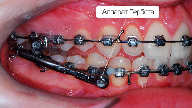 Выравнивание зубов брекетами