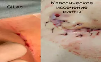 Что такое киста копчика?