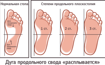 2 степень плоскостопия: категория и особенности
