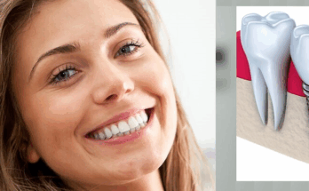 Преимущества имплантации зубов для восстановления улыбки и здоровья полости рта