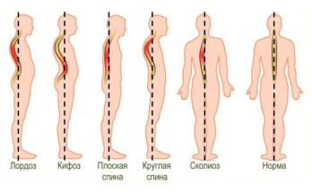 Что вредно для здоровья спины Что вредно для здоровья спины