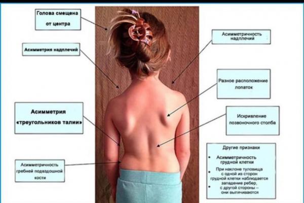Профилактика сколиоза у детей