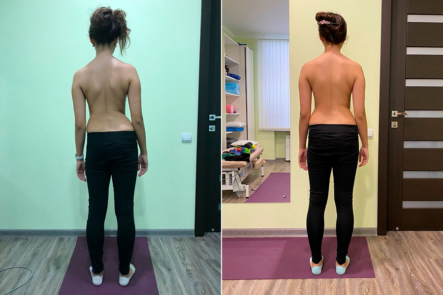 Как уберечь себя от сколиоза