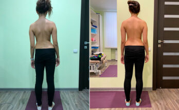 Как уберечь себя от сколиоза Как уберечь себя от сколиоза