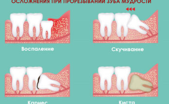 Особенности процедуры удаления зуба в Москве