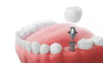 Что такое имплантация зубов?